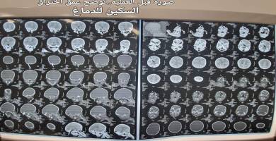 صورة مفراس لجمجمة الطفل